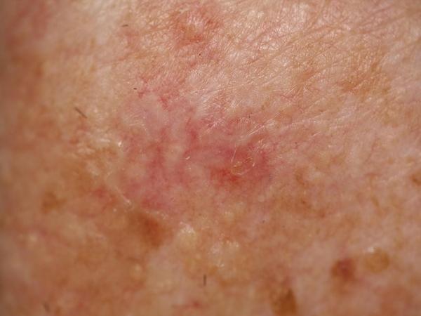 Clinical photograph: Basal cell carcinoma on the trunk of a 