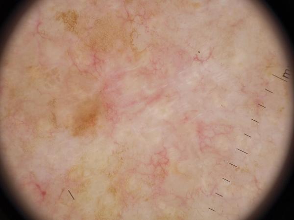 Dermoscopic image: Basal cell carcinoma on the trunk of a 75
