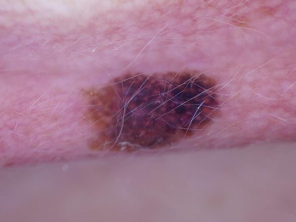 Dermoscopic image: Invasive melanoma on the ear, under 0.8 m